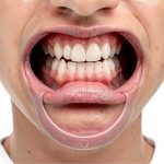 Speak Out Dental Cheek Retractor CN 15 pcs Clear C Shape Mouth Opener-0