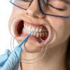 Mouth Openers 10 PCS Set by FAQQI Cheek Retractor for Kids and Adults-4